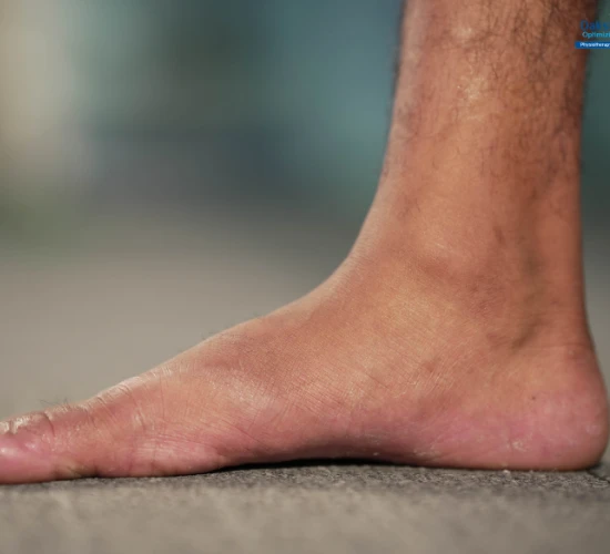 Flat Feet Treatment Hyderabad