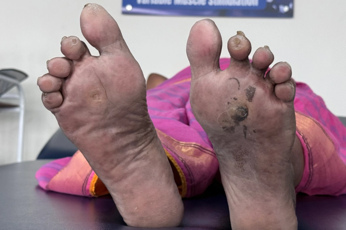 Custom diabetic footwear fitting