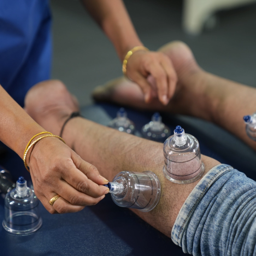 Cupping Therapy & Dry Needling