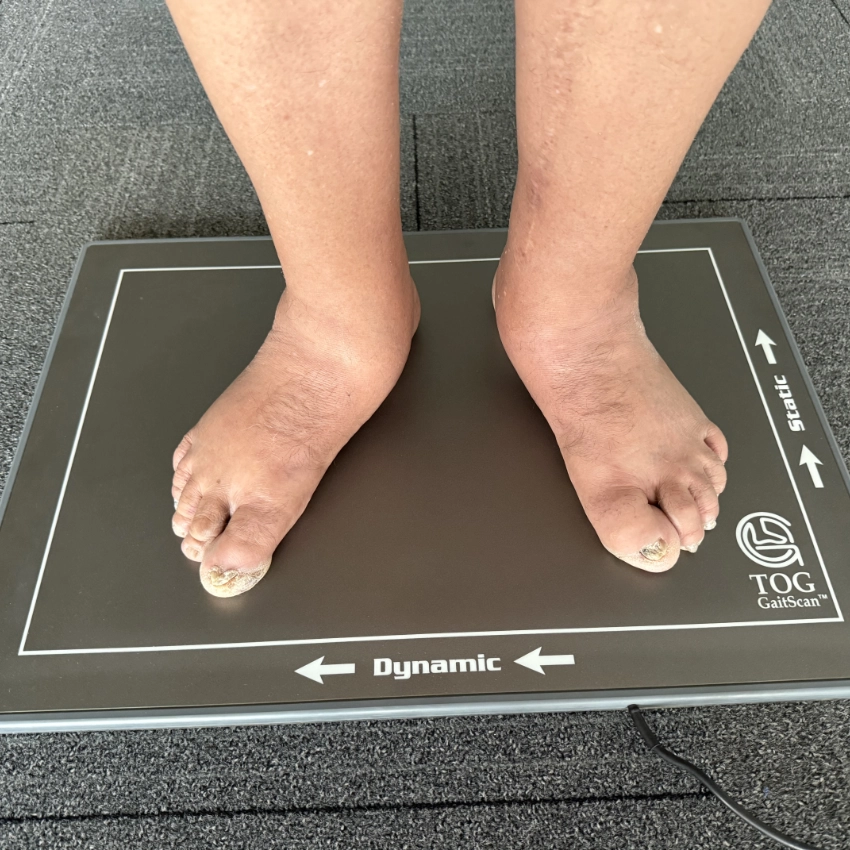 Diabetic Foot Care & Prevention